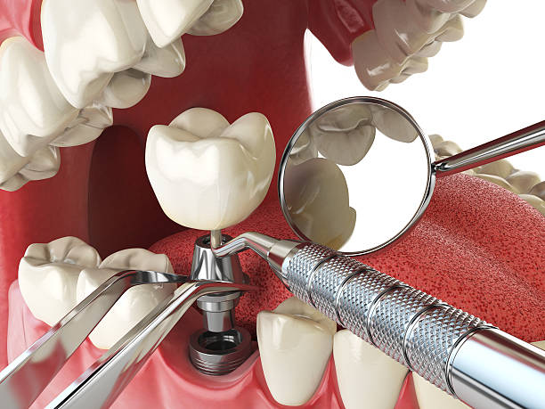 Best Emergency Tooth Extraction in Lookout Mountain, AL